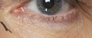 eye with cut lines on skin