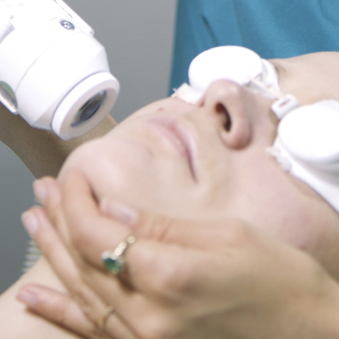 Laser Resurfacing